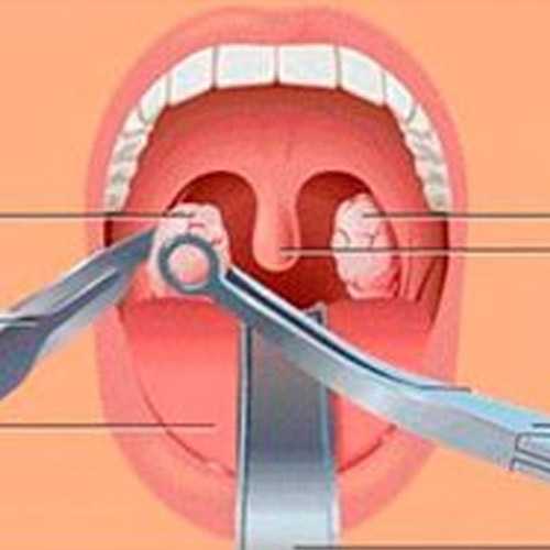 CIRURGIA DE ADENOIDECTOMIA E AMIGDALECTOMIA EM BLUMENAU