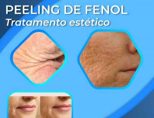 Tratamento Estético com Peeling de fenol